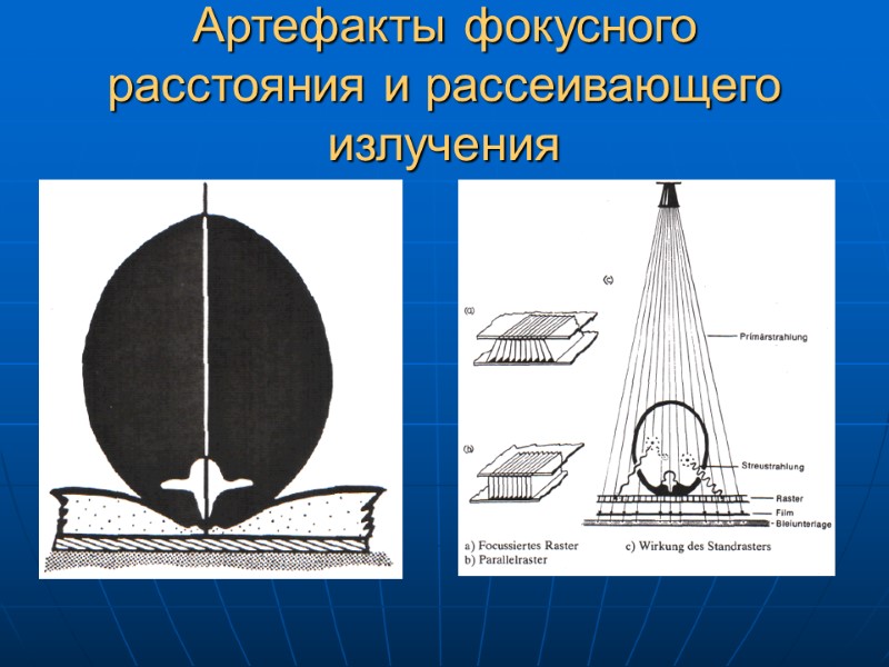 Артефакты фокусного расстояния и рассеивающего излучения